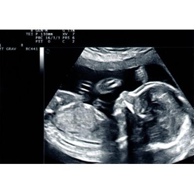 ultrasound scan baby Thumbnail